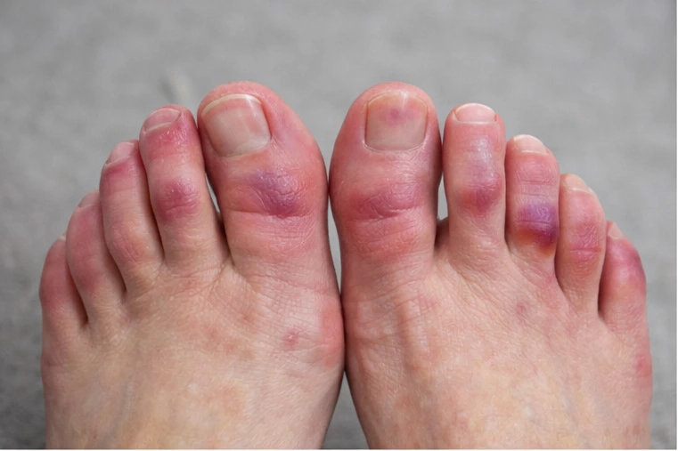 Sabañones en los pies: por qué aparecen y cómo tratarlos